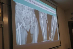 Un caso único en Misiones: el Hospital Madariaga trató una fractura de cadera vinculada a una rarísima enfermedad genética