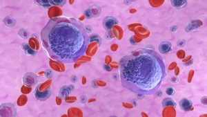 9 de cada 10 pacientes con leucemia linfocítica crónica no reconocen los síntomas antes del diagnóstico
